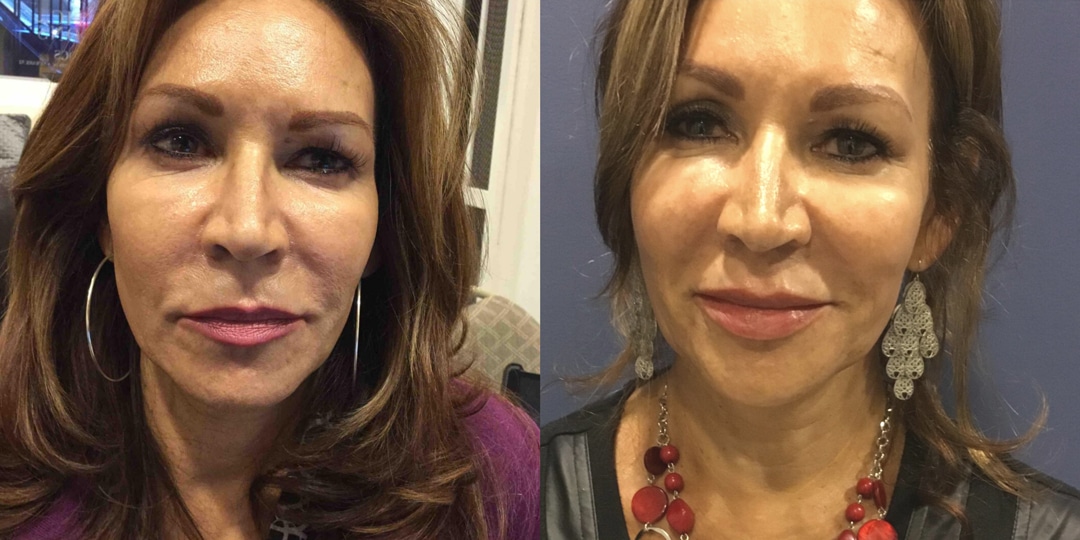 Side-by-side headshots of the same woman depicting Botox before and after.