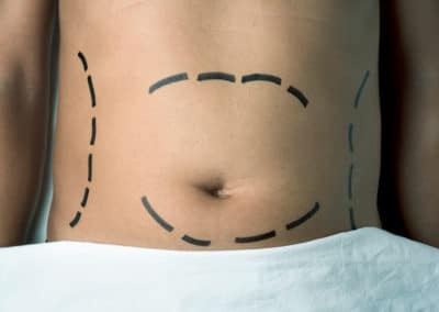 If I Keep Gaining Weight, is Liposuction a Good Idea For Me?
