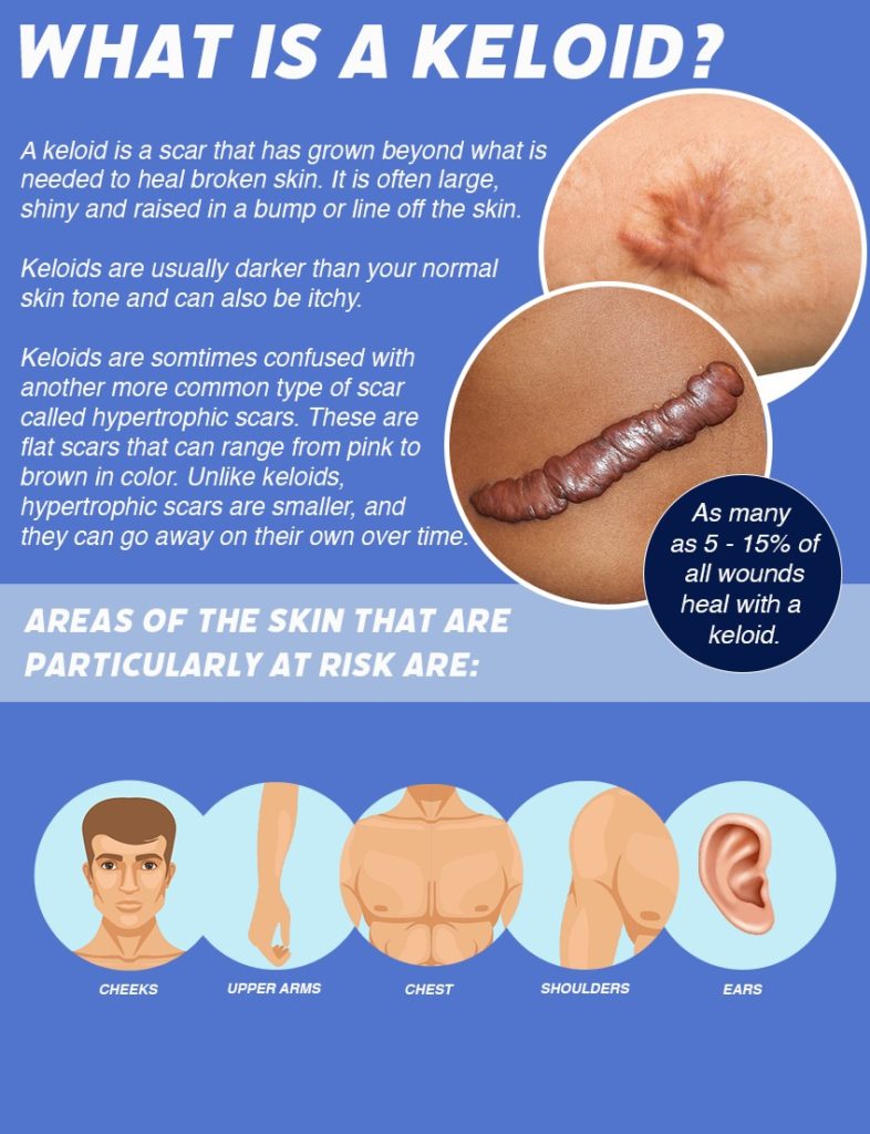 What are Keloids? - Lexington Plastic Surgeons