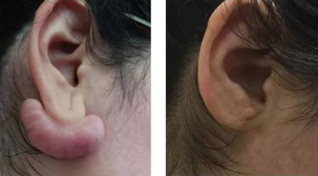 ear keloid removal before and after with keloid removed from earlobe