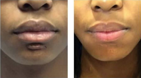 chin keloid removal before and after with keloid removed from under lips with minimal scarring, will heal over time and make scar nearly invisible
