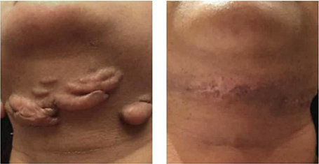 keloid removal before and after with keloids on neck removed with minimal scarring