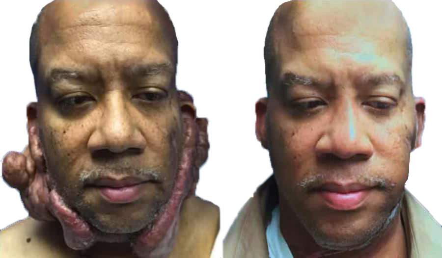 keloid removal before and after with large keloids removed from chin and sides of head with minimal scarring, complete face transformation