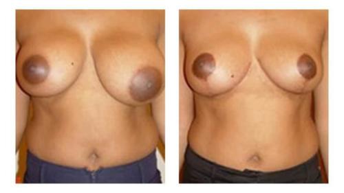 Breast-Augmentation-10 Before-After Dr-Michael-Jones