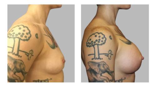 Breast-Augmentation-1 Before-After Dr-Charlie-Chen
