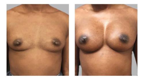 Breast-Augmentation-1 Before-After Dr-Gerald-Ginsberg