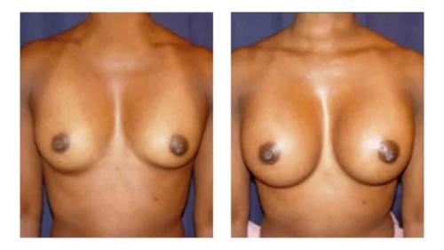 Breast-Augmentation-1 Before-After Dr-Michael-Jones