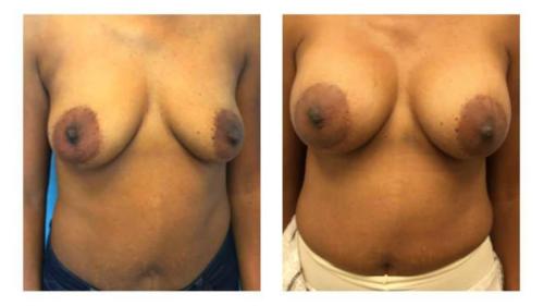Breast-Augmentation-1 Before-After Dr-Nicholas-Jones