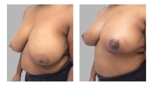 Breast-Augmentation-1 Before-After Dr-Stanley-Ogu
