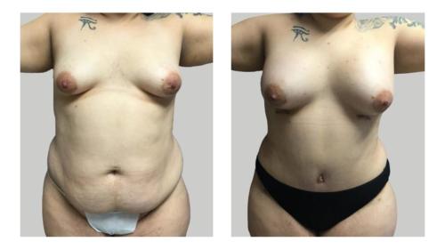 Breast-Augmentation-2 Before-After Dr-Abel-Giorgis