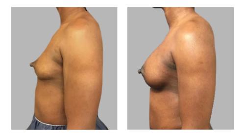 Breast-Augmentation-2 Before-After Dr-Gerald-Ginsberg
