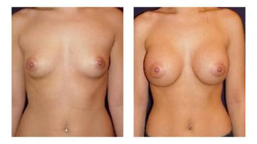 Breast-Augmentation-2 Before-After Dr-Michael-Jones