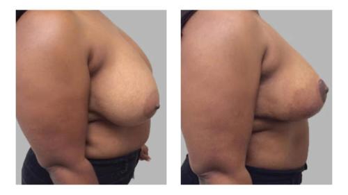 Breast-Augmentation-2 Before-After Dr-Stanley-Ogu