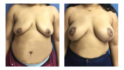 Breast-Augmentation-3 Before-After Dr-Abel-Giorgis
