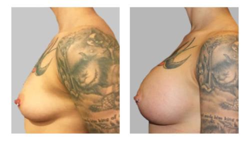Breast-Augmentation-3 Before-After Dr-Charlie-Chen