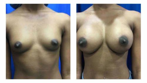 Breast-Augmentation-3 Before-After Dr-Gerald-Ginsberg