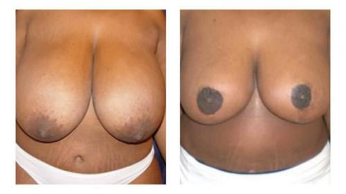 Breast-Augmentation-3 Before-After Dr-Michael-Jones
