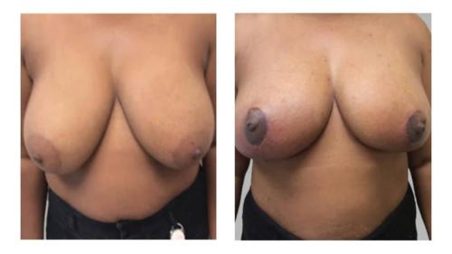 Breast-Augmentation-3 Before-After Dr-Stanley-Ogu
