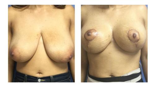 Breast-Augmentation-4 Before-After Dr-Abel-Giorgis