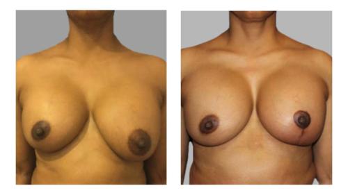 Breast-Augmentation-4 Before-After Dr-Charlie-Chen