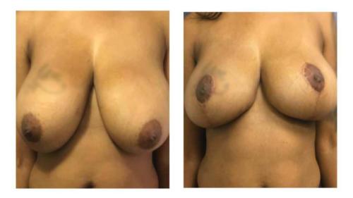 Breast-Augmentation-4 Before-After Dr-Gerald-Ginsberg