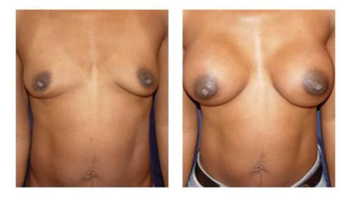 Breast-Augmentation-4 Before-After Dr-Michael-Jones