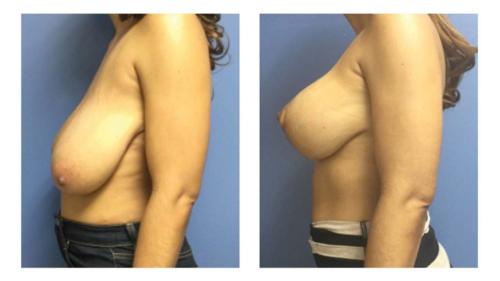 Breast-Augmentation-5 Before-After Dr-Abel-Giorgis