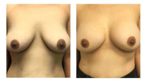 Breast-Augmentation-5 Before-After Dr-Gerald-Ginsberg