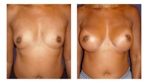 Breast-Augmentation-5 Before-After Dr-Michael-Jones