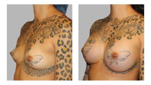 Breast-Augmentation-6 Before-After Dr-Charlie-Chen