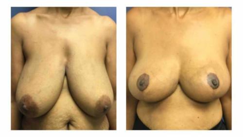 Breast-Augmentation-6 Before-After Dr-Gerald-Ginsberg
