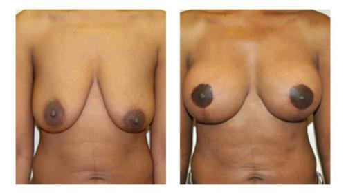 Breast-Augmentation-6 Before-After Dr-Michael-Jones