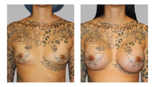 Breast-Augmentation-7 Before-After Dr-Charlie-Chen