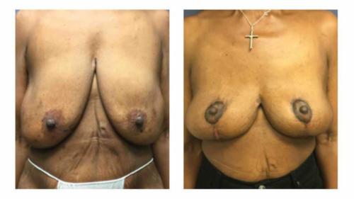 Breast-Augmentation-7 Before-After Dr-Gerald-Ginsberg