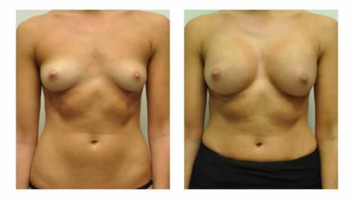 Breast-Augmentation-7 Before-After Dr-Michael-Jones