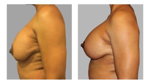 Breast-Augmentation-8 Before-After Dr-Charlie-Chen
