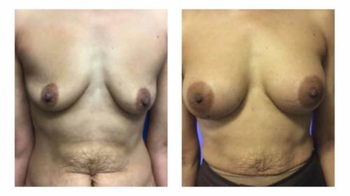 Breast-Augmentation-8 Before-After Dr-Gerald-Ginsberg