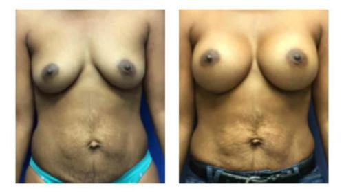 Breast-Augmentation-8 Before-After Dr-Michael-Jones