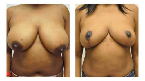 Breast-Augmentation-9 Before-After Dr-Michael-Jones