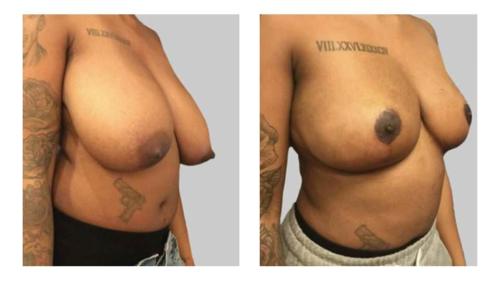 Breast-Reduction-2 Before-After Dr-Michael-Jones