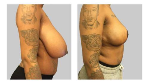 Breast-Reduction-3 Before-After Dr-Michael-Jones
