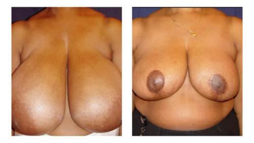 Breast-Reduction-4 Before-After Dr-Michael-Jones