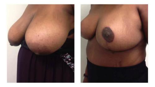 Breast-Reduction-5 Before-After Dr-Michael-Jones