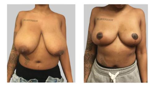 Breast-Reduction Before-After Dr-Michael-Jones