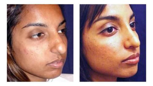 Facial-Surgery-10 Before-After Dr-Michael-Jones