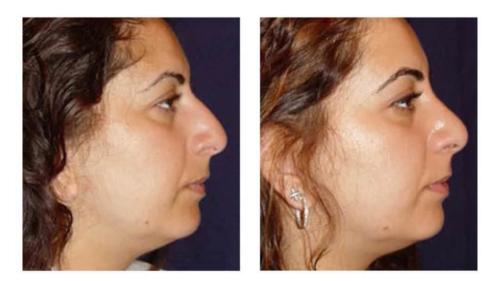 Facial-Surgery-11 Before-After Dr-Michael-Jones