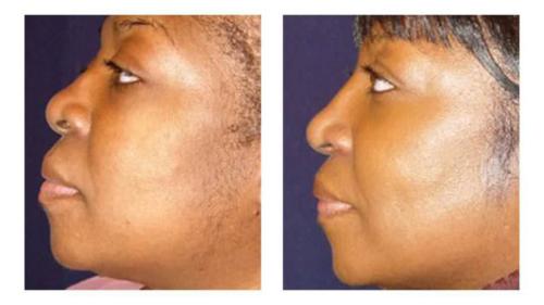 Facial-Surgery-12 Before-After Dr-Michael-Jones