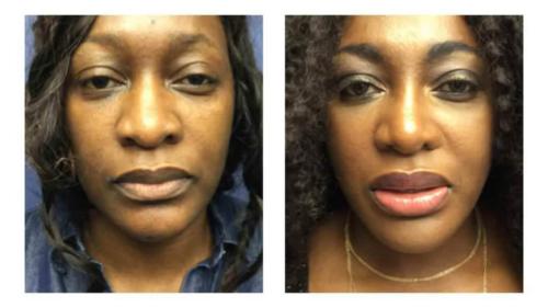 Facial-Surgery-13 Before-After Dr-Michael-Jones