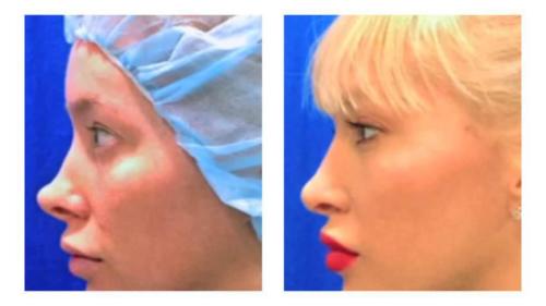 Facial-Surgery-14 Before-After Dr-Michael-Jones