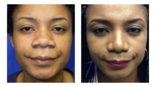 Facial-Surgery-15 Before-After Dr-Michael-Jones